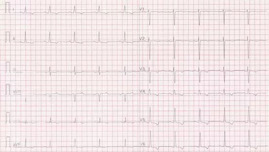 专栏丨贾卫滨：心电图“掉头”现象的定义与诊断特征（1）