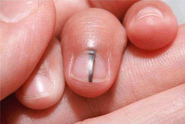 指甲有没有恶性肿瘤,指甲白线良性肿瘤
