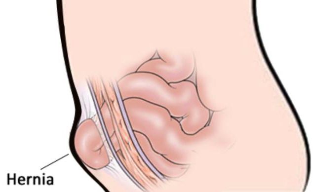 勿以“疝”小而不为，也有可能随时会要命