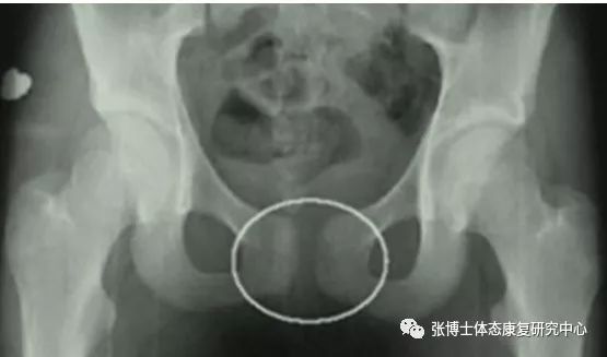 「产后康复」产后耻骨联合分离、耻骨疼痛的原因、诊断与康复方法