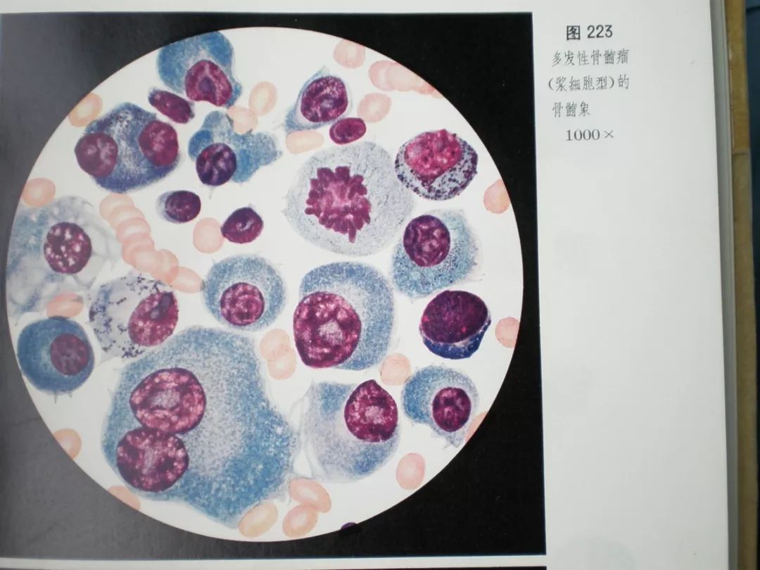 全血细胞减少疾病，你还傻傻分不清？