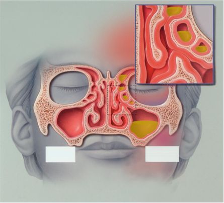 过敏性鼻炎日常生活需要注意什么,过敏性鼻炎平时饮食要注意什么