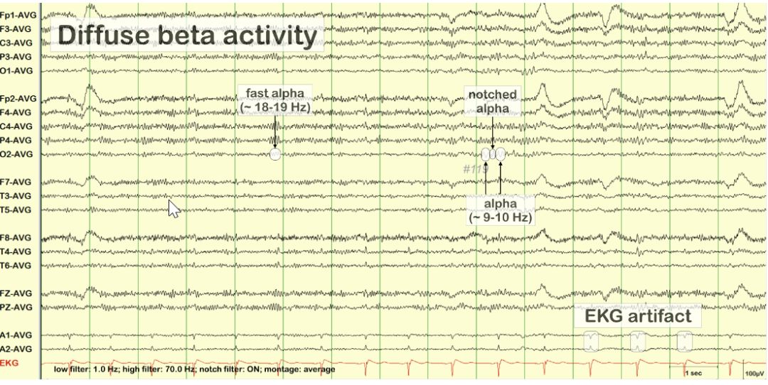 脑电图伪差图,脑电图伪差图谱