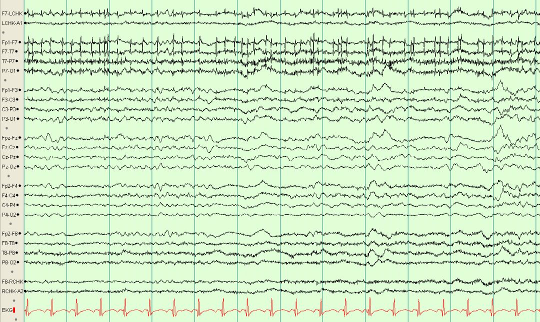 脑电图伪差图,脑电图伪差图谱