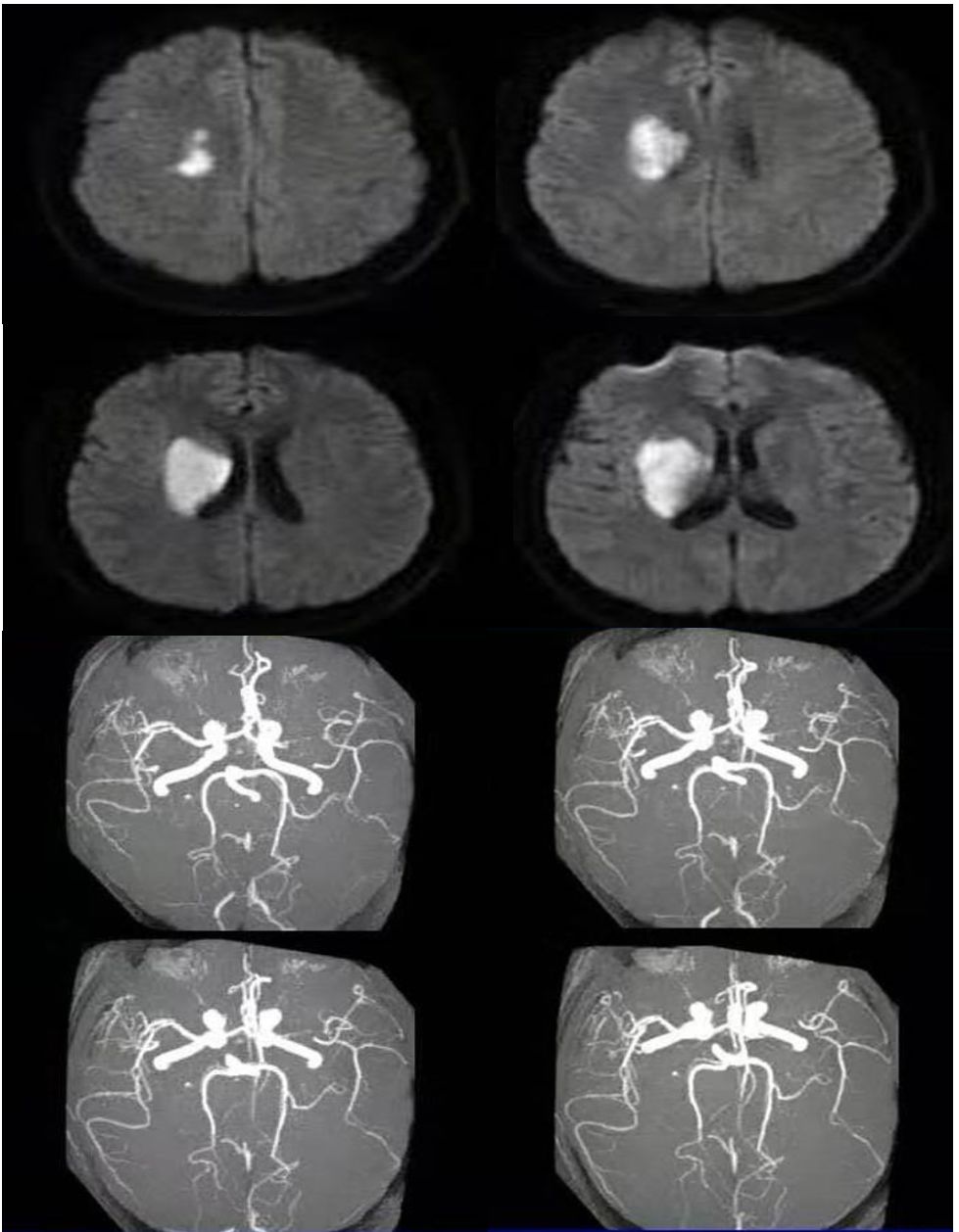 高氨血症有哪些表现,高氨血症