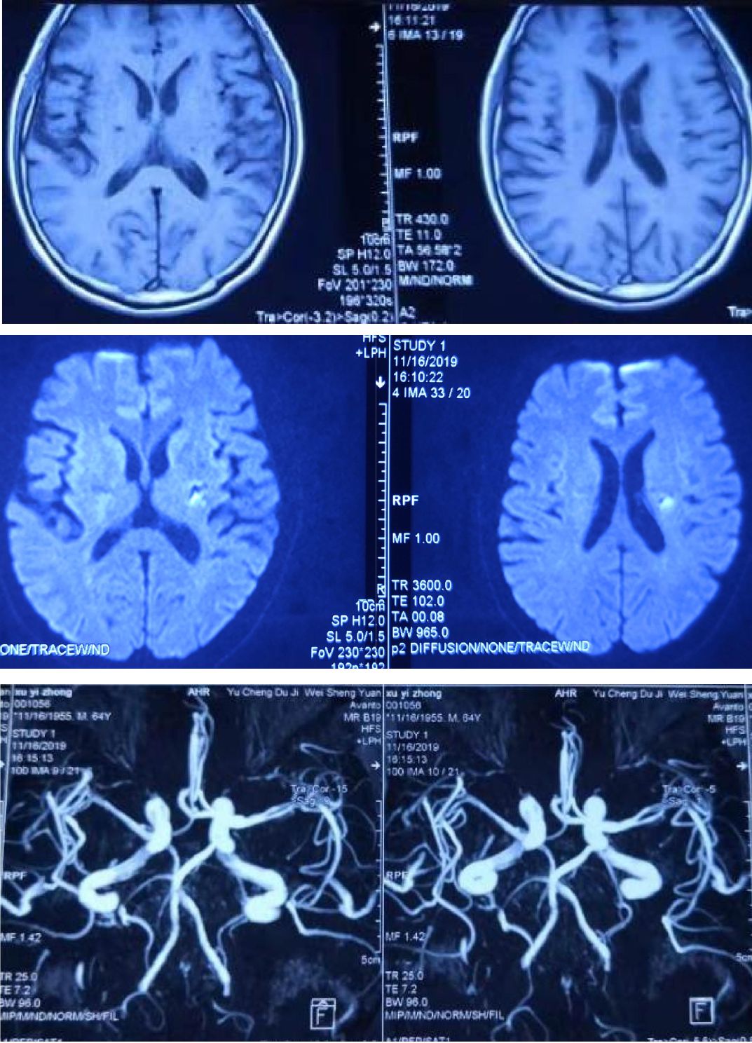 高氨血症有哪些表现,高氨血症