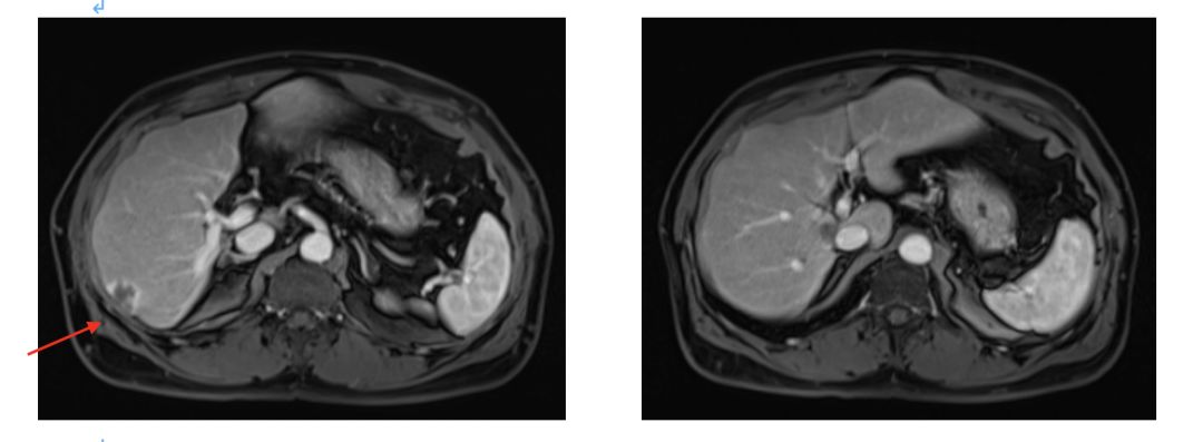 升结肠癌肝转移，如何实现治愈“神话”？|病例分享