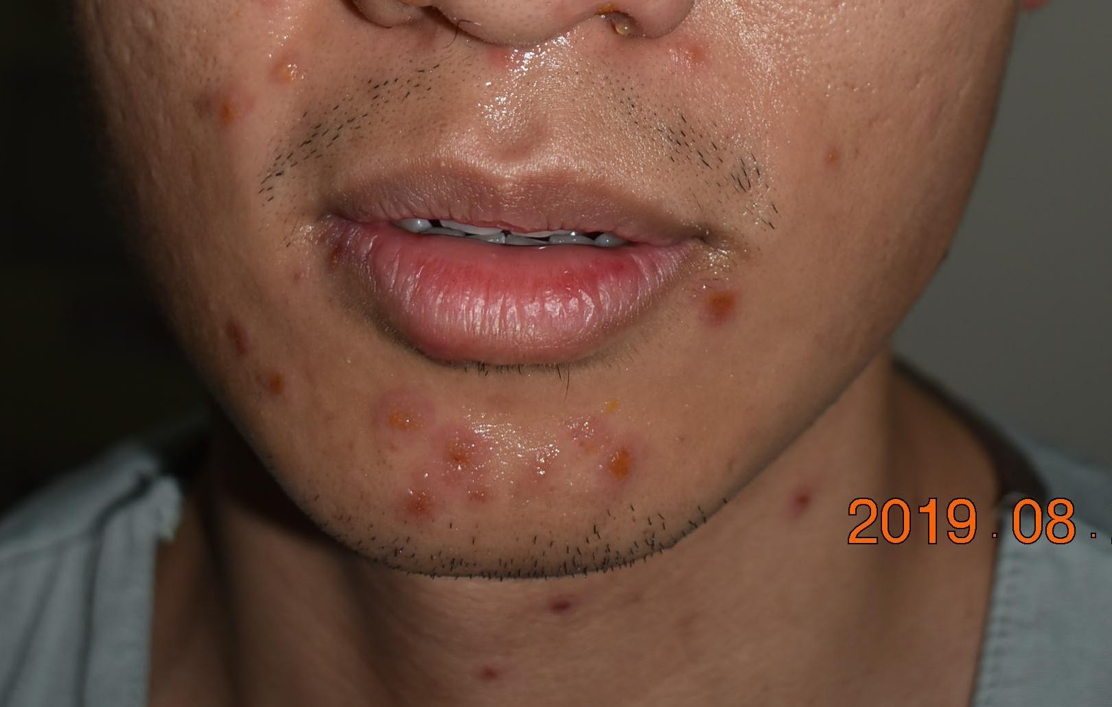 大人感染轮状病毒一直拉肚子,大人得肠病毒