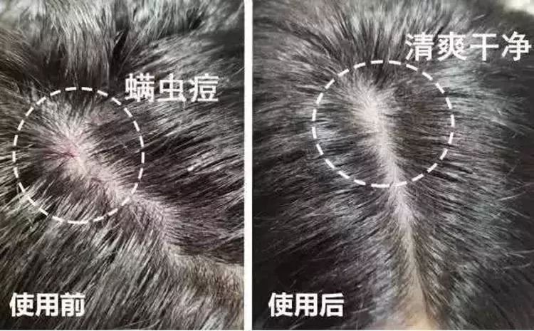 头皮痒头屑多有头螨怎么办,头螨大块头屑怎么治好得快