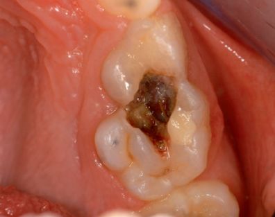 关爱口腔预防龋齿,爱牙科普小实验