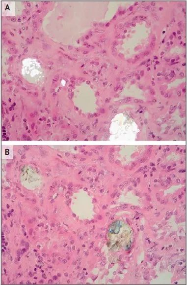 非布司他引起肾衰竭,吃奥利司他2年肾脏衰竭