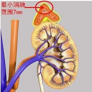 在线心内会诊室丨原醛治疗,“柳暗花明又一村”