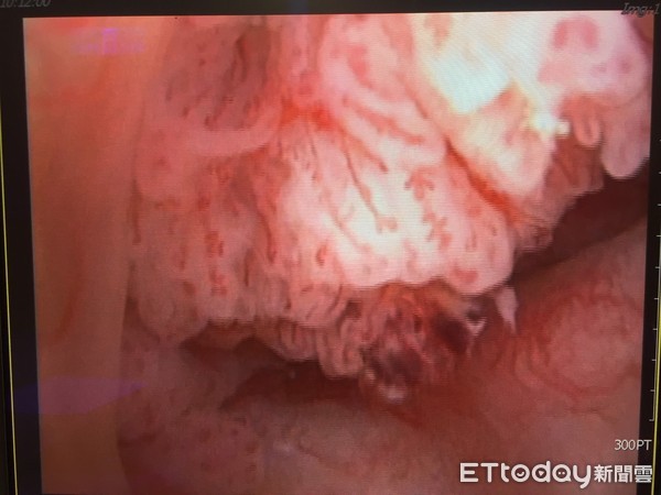 尿出血一点点是什么原因,尿出血了