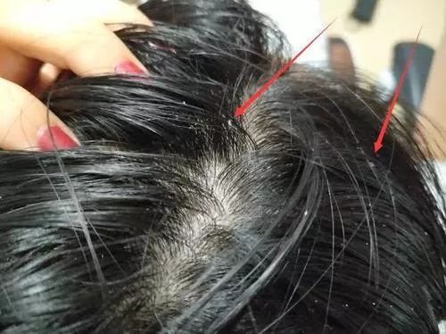 头上又油又有头皮屑又痒怎么办,头上又痒又油有头屑