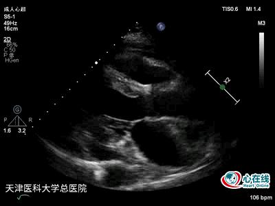 超声心动图发现赘生物,超声心动图检查结果疑似赘生物