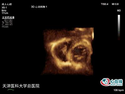 超声心动图发现赘生物,超声心动图检查结果疑似赘生物