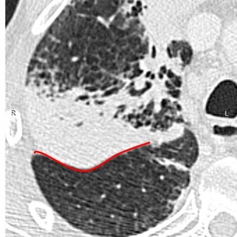 肺炎克雷伯化脓性脑膜炎,肺炎克雷伯菌的研究动态