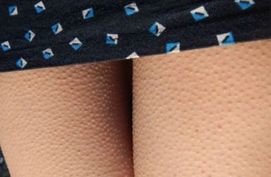 前胸鸡皮痘痘怎么处理,胸背痘痘清理