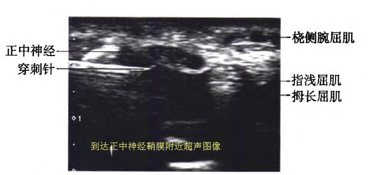 超声波注射治疗腕管综合征效果,超声引导局部注射治疗腕管综合征