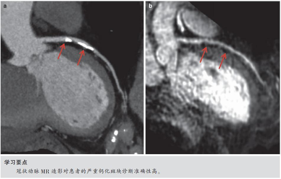 怎么看懂ct冠状动脉造影图片,冠状动脉造影图讲解