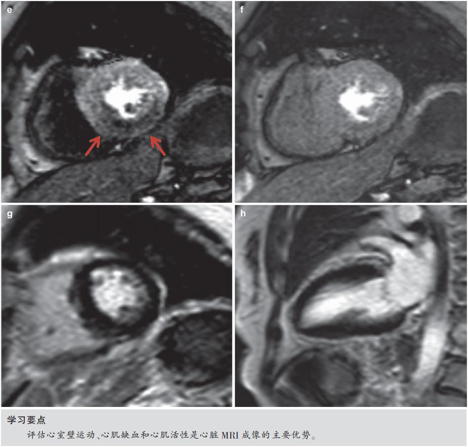 怎么看懂ct冠状动脉造影图片,冠状动脉造影图讲解