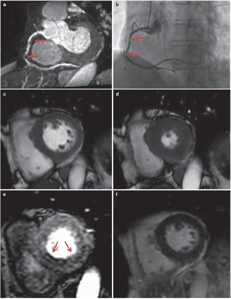 怎么看懂ct冠状动脉造影图片,冠状动脉造影图讲解