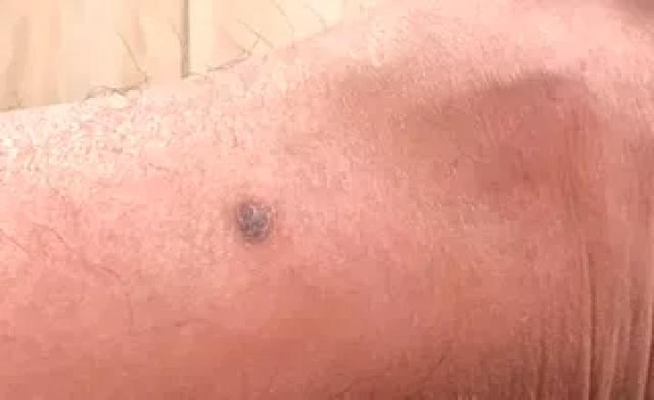 黑痣癌变的痣会很大吗,黑痣癌变一般是一个痣还是好多