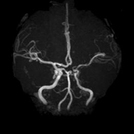 左侧大脑后动脉开窗畸形图片,脑部基底动脉开窗畸形如何治疗