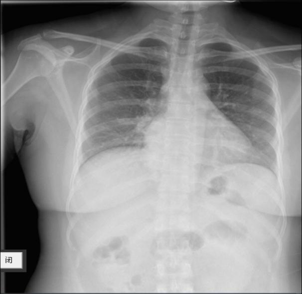 反复发热肺里有痰,干咳是肺部感染引起的吗