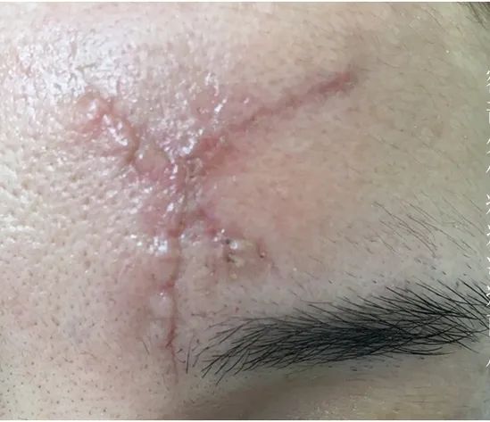 瘢痕体质留疤了怎么办,只有开刀才长疤是瘢痕体质吗