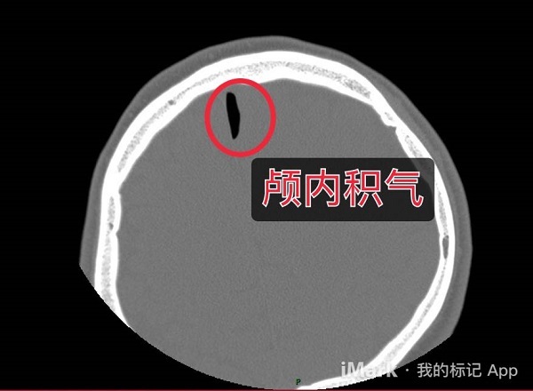 脑子进风了怎么治疗,脑子里进气是什么原因引起的