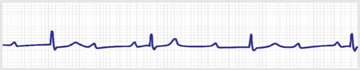 心动过缓不要慌,心脏起搏器来帮忙