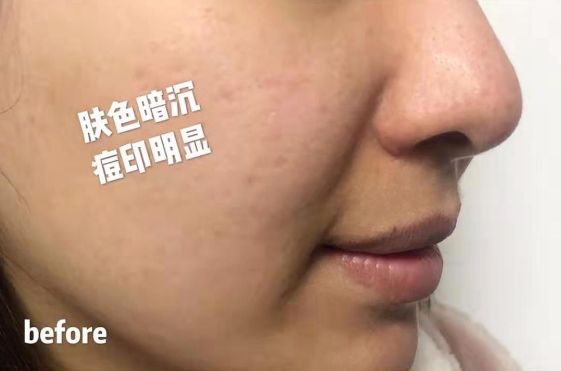 长期补充胶原蛋白的人怎么样了,长期喝胶原蛋白的人最后怎么样了