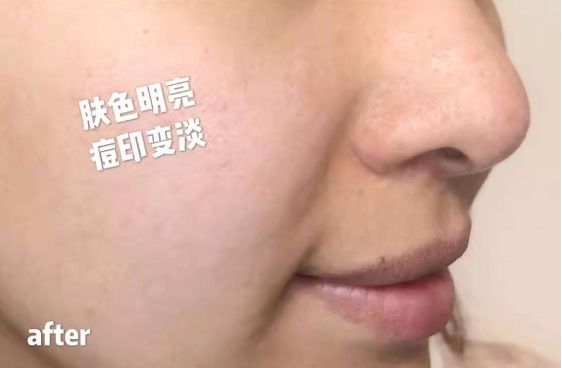 长期补充胶原蛋白的人怎么样了,长期喝胶原蛋白的人最后怎么样了