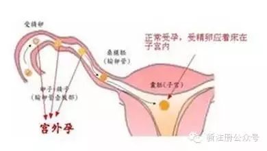 早孕见红怎么回事,早孕生气会见红