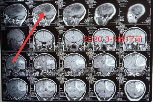 湖南一大爷2月前头痛欲裂2月后行走如常，陀螺刀解患者难题