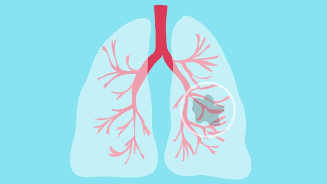 同一个肺结节复查形状有变化,这5种情况警惕肺结节发展为肺癌