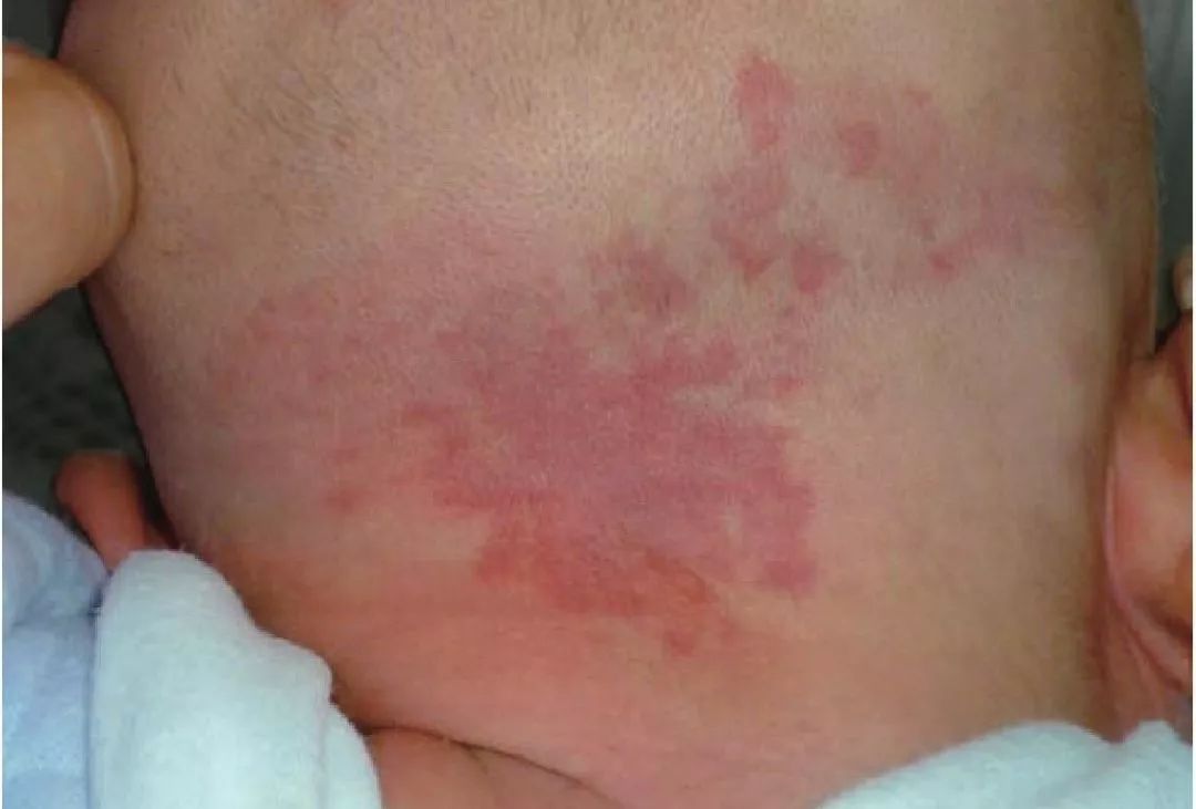 宝宝眼睛下面发青鼻子有青筋,宝宝鼻梁上有淤青怎么回事