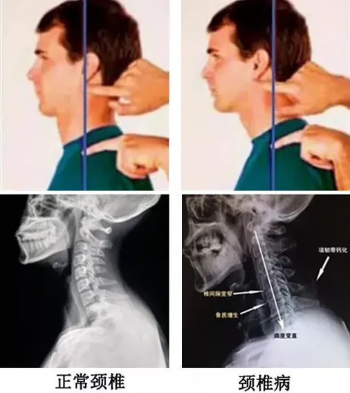 颈椎磁疗法,颈椎正骨咔咔响原声