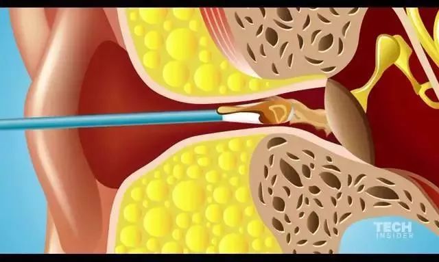 棉签抠耳朵导致癫痫,用棉签掏耳朵不小心被撞了一下