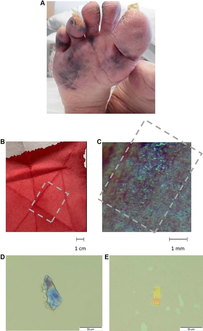 95岁老爷爷脚趾变形,90岁老人脚趾头发黑怎么办