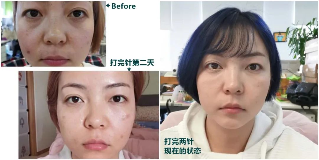 做完医美真的能换脸吗,做完医美需要注意什么