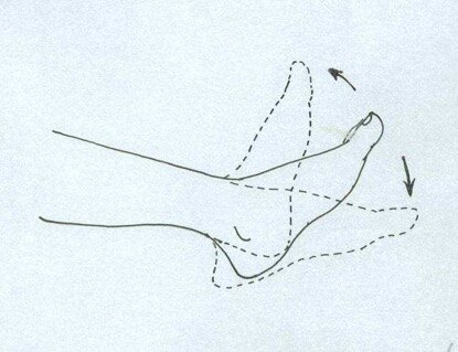 骨科大手术深静脉血栓预防指南,卧床病人如何预防深静脉血栓