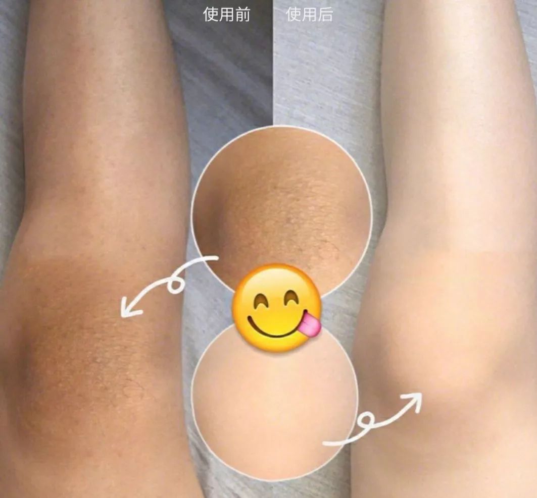 为什么夏天不露腿了,夏天不露腿热吗