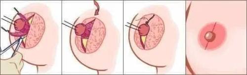 19岁女孩乳头一直没长出来父母后悔听信“老人言”