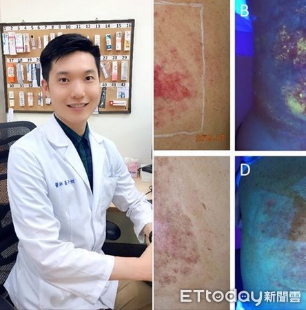 慢性砷中毒可疑皮肤癌挂哪科最好,砷中毒的皮肤病能治好吗