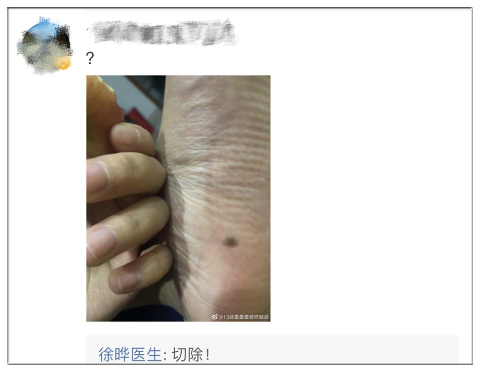 什么样的痣需要提高警惕,什么样的痣要引起重视