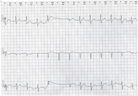 各种心律失常心电图巧记方法,常见心律失常的心电图表现与处理