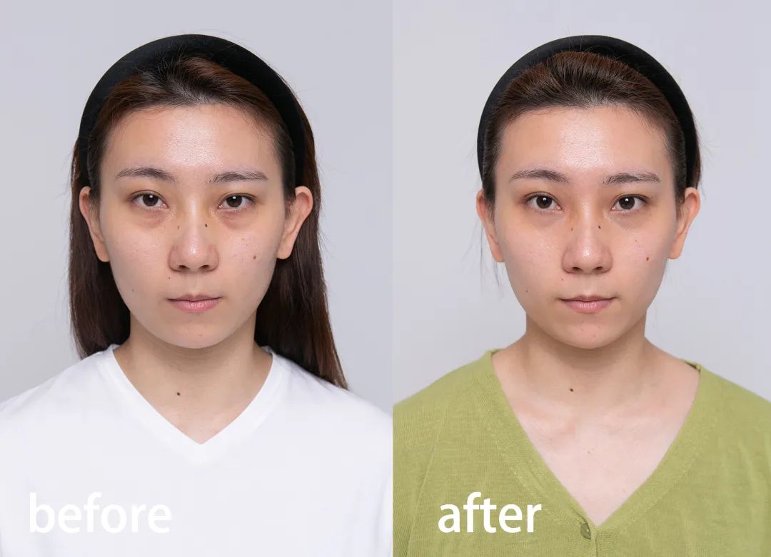 两边黑眼圈程度不一样,黑眼圈的秘密暴露了一个真相