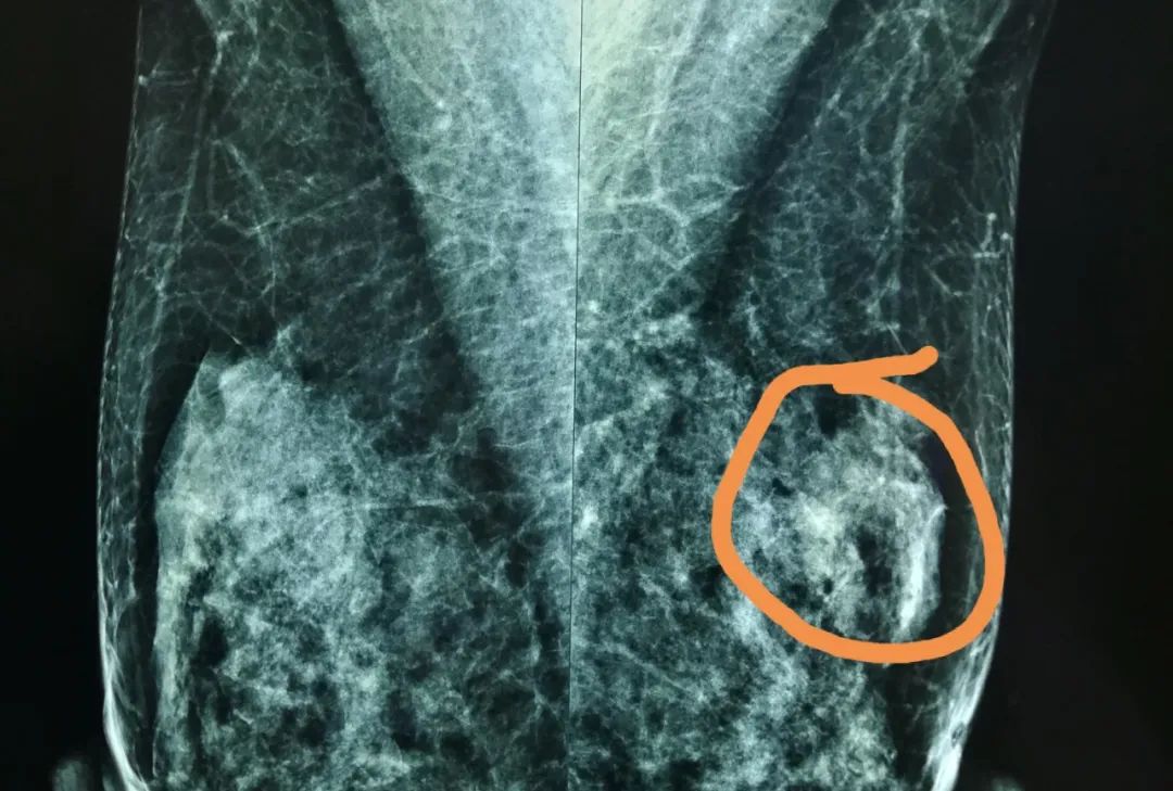 【专家在身边】“黄豆”大小的结节竟是乳腺癌？只能一切了之？专家给出了这样的答案……